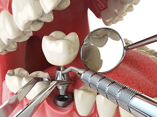 Best Emergency Wisdom Teeth Removal in Beaufort, NC